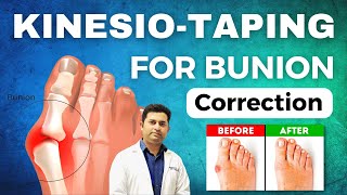 GREAT TOE CORRECTION BY RIGID / KINESIO-TAPING IN BUNION : LEARN THE METHOD FOR BEST RESULTS