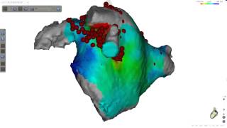 Focal atrial tachycardia originating at coumadin ridge of the left atrium.