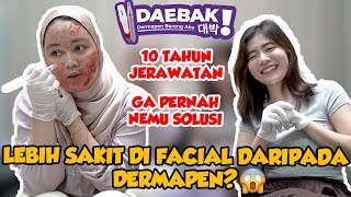 HAMPIR 10 TAHUN, GA NEMU SOLUSINYA! - DERMAPEN SOLUSINYA "LEBIH SAKIT FACIAL DARIPADA DERMAPEN"