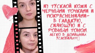 ЧЕРНЫЕ ТОЧКИ, ШЕЛУШЕНИЯ, НЕРОВНЫЙ ТОН - покажу КАК ИЗБАВИТЬСЯ ОТ ЭТОГО