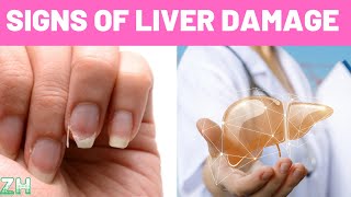 Signs That Your Liver is Damaged | Liver Disease Signs and Symptoms