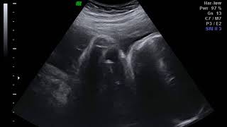 My 3D/4D Ultrasound