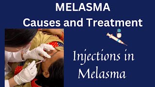 Melasma explained in detail| Causes | Risk factors | Pathophysiology | BestTreatment and Injections