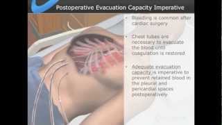 Cardiovascular Surgical Symposium, 2013 - Part 1, Chest Tube Clogging Impairs Evacuation Capacity