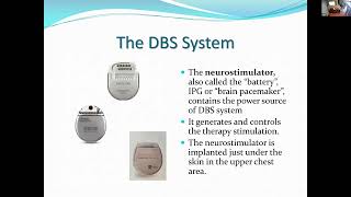 Learn About Deep Brain Stimulation (DBS)