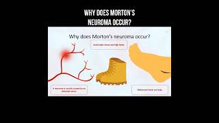 Why does Morton's neuroma occur? #morton #neuroma #inflammation #nervepainrelief