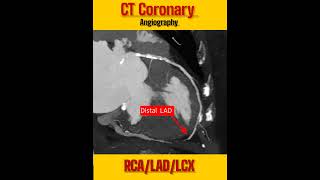 Rad Shorts/ CT Coronary  Angiography/RCA/LM/LAD/LCX