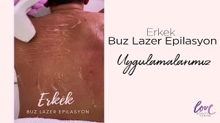 Erkek Buz Lazer Epilasyon