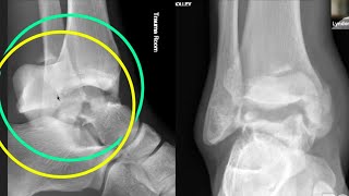 Talus Fractures and Dislocations