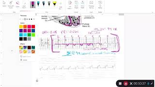 Sinus Rhythm Identification