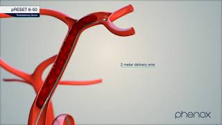 phenox | pRESET 6-50 | Thrombectomy Device