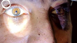 Ophthalmic Signs Trauma