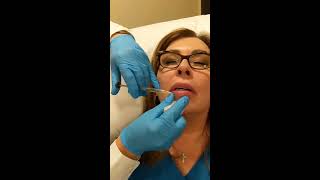 Dr. Damico Juvederm Lips