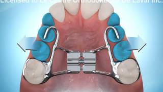 Expansion palatine en dentition mixte (jeune)- Palatal expander (youth)