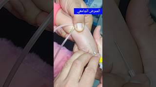 تركيب كانيولا للأطفال Cannula insertion for children