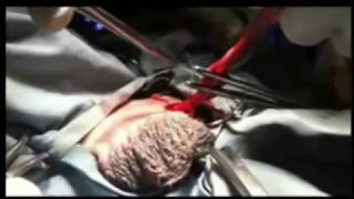 CASTRATION SURGERY FOR DOG NEUTERING ||  OPEN METHOD TO EMASCULATE