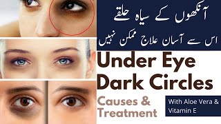 Dark Circles - 100% Remove Dark Circles | Aloe Vera & Vitamin E Treatment | Healthcare Remedy