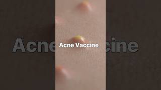 Acne Vaccine: A Breakthrough in Skin Care? #Vaccine #science #medicine #acne #dermatology