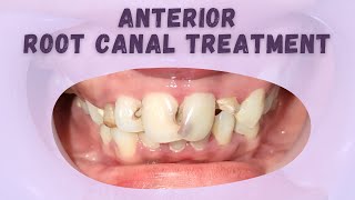 WDC_ANTERIOR ROOT CANAL TREATMENT WITH FIBER AND COMPOSITE DIRECT RESTORATION 🦷 | ENDODONTIC | RCT