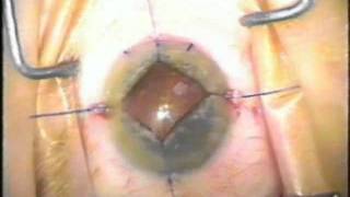 Iris Retractor