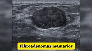 TENGO FIBROADENOMAS HACE 12 AÑOS ME BIOPSIARON ME DIJERON QUE ERA BENIGNO | bolita en los senos