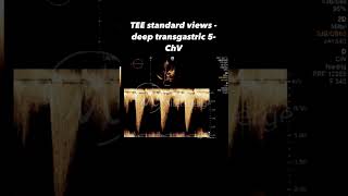 TEE standard - deep transgastric 5-ChV & CW