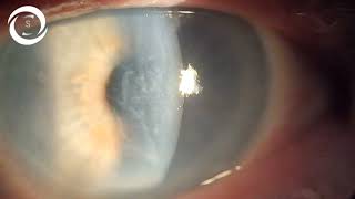 Striate keratopathy due to intracameral use of adrenaline