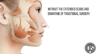 MyEllevate by Dr. Darren Smith: NYC's Minimally Invasive Neck Lift