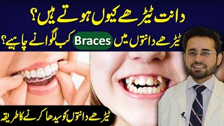 Crooked Teeth Treatment In Urdu | Tedhe Daanton Ko Seedha Karne Ka Tarika | Dr Mannan Azhar