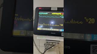 #ecg complete heart block- more P than QRS, no relation between P & QRS, regular RR interval