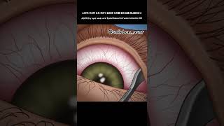 ASMR 눈꺼풀 피지 압출 애니메이션 2 | 눈기름샘 청소 | 마이봄샘 #shorts #treatment #dentalcare #trending