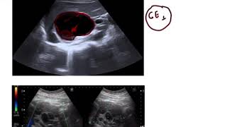 Hydatid Cyst of liver STAGING