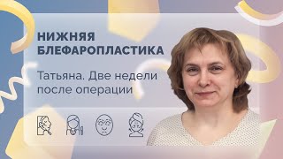 Татьяна. Нижняя блефаропластика. 14 сутки после операции