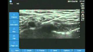 Ultrasound Guided Supraclavicular block