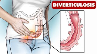 Understanding Diverticulosis and Diverticulitis-Doctor Explains