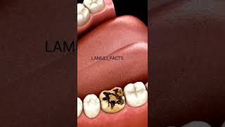 HOW DENTAL CROWN WORKS #shorts #ytshorts #viralshorts #trendingshorts #youtubeshorts