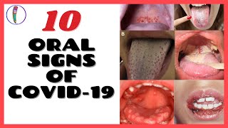 ORAL SIGNS OF CORONAVIRUS (COVID 19) / CORONAVIRUS SYMPTOMS