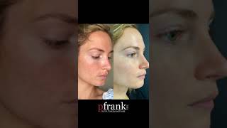 Treating Melasma and Pigment