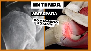 Entenda a Artropatia do Manguito Rotador