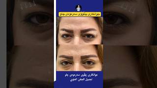 تجمیل الجفون العلوی. #تجميل_العيون