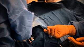 TLAB Transjugular Liver Biopsy Procedure Video