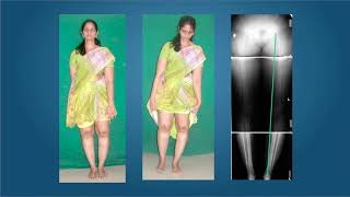 High Tibial Osteotomy using frames - Milind Chaudhary, India