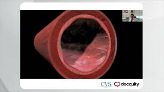 CVSKL Docquity EP09: Recent Development in The Cardiac Catheter Lab by Dr. Lawrence Chan