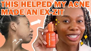 Ayshea's ex-zit journey with APRILSKIN