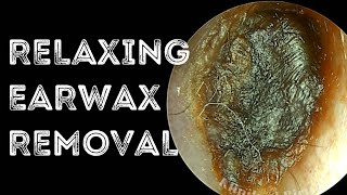 Relaxing Deep Impacted Earwax Removal