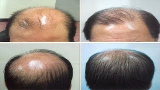 Natural methods to cure baldness and hair regrowth (Works 100%)