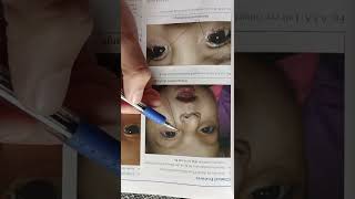 lacrimal system of eye part 1