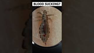 Human head Louse under microscope video |Head Lice under microscope view | Pediculus humanus capitis