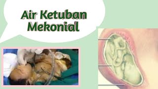 Mengenal Air Ketuban Mekonial - Meconium Aspiration Syndrome