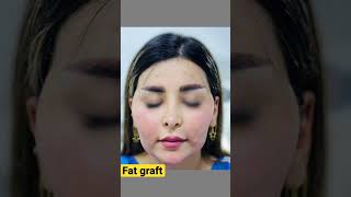 Fat graft for face contouring.دانانەوەی چەوری خۆی بۆ دەم و چاو.#fatgrafting